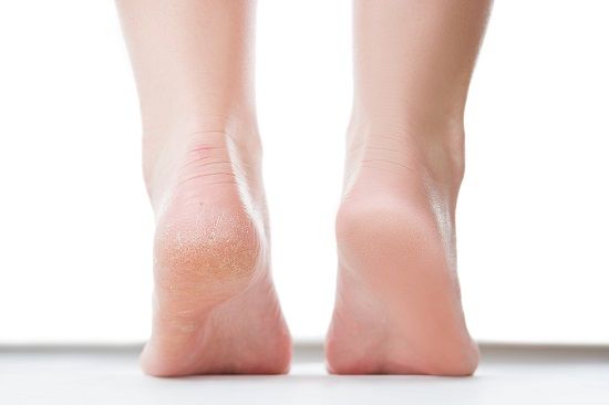 وصفات للتخلص من تشقق الكعبين وصفات للتخلص من تشقق الكعبين
