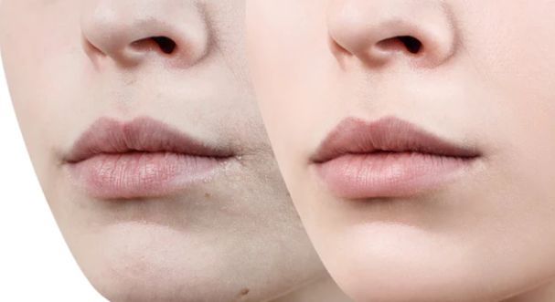طرق طبيعية لتفتيح منطقة حول الفم طرق طبيعية لتفتيح منطقة حول الفم