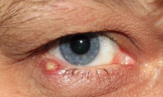 تفسير حلم خروج القيح من العين في المنام