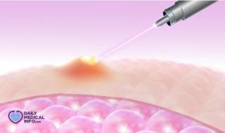 التورم والصديد من الأعراض التي يشترك فيها #الدمل و #الخراج، حيث أنهما غالباً ما يكونا نتيجة الإصابة بعدوى بكتيرية! فما الفرق بين الدمل والخراج؟ اكتشف من هنا