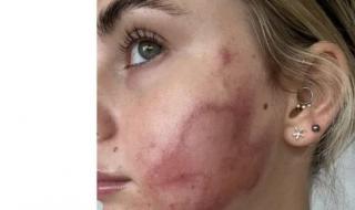أمريكية تصاب بحروق بوجهها بعد جلسة تجميل فاشلة بتقنية المايكرونيدلينج