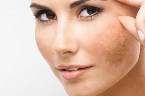 طرق مهمة لعلاج تصبغات الجلد